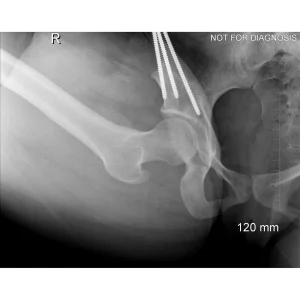 Long-term follow-up X-ray showing excellent implant osseointegration at 7 years.