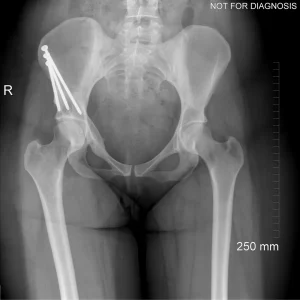 Durable implant fixation and preserved bone stock seven years post-surgery.