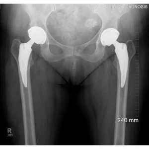 Bilateral Total Hip Replacements