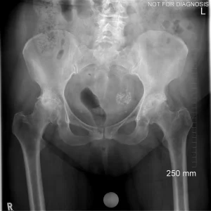 Bilateral Hips - Pre-operative