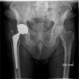 Cup Revision Post - Clinical X-ray view.