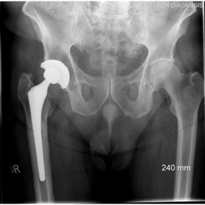 Cup Revision Pre - Clinical X-ray view.