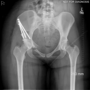 Immediate post-operative X-ray confirming implant seating and initial stability.