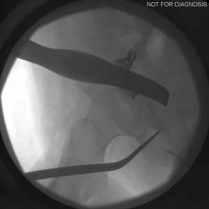 Intra-operative fluoroscopy confirming initial landmark identification.