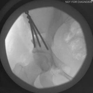 Final view of definitive implants in situ.