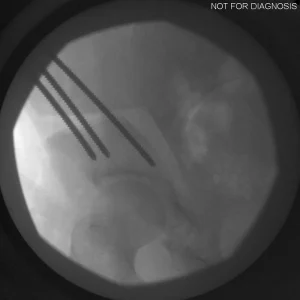 Final fluoroscopic confirmation of implant reduction before closure.