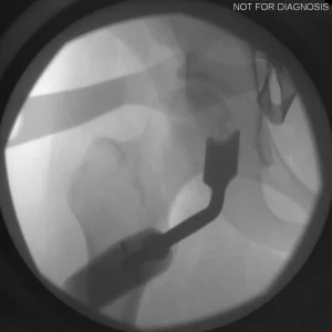 Fluoroscopic verification of acetabular reaming depth and orientation.