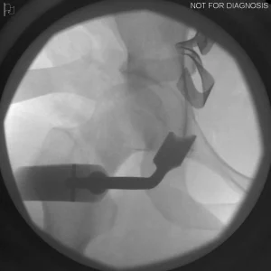 Assessment of trial components to test hip stability and range of motion.