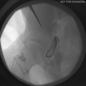 Verification of acetabular cup seating and inclination angle.