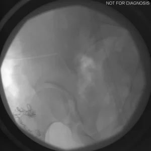 Fluoroscopic check of femoral broach sizing and alignment.