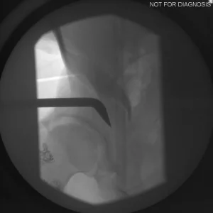 Initial reduction of the hip joint with trial components.