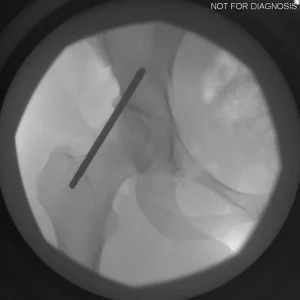Intra-operative measurement of leg length equality.