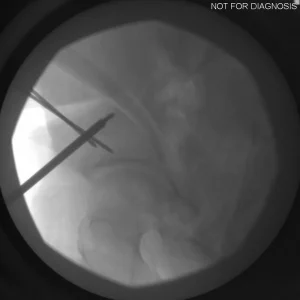 Confirmation of femoral offset and tissue tension.