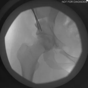 Fluoroscopic stress test to ensure no impingement or instability.