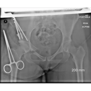 Real-time intra-operative imaging used to confirm component position during surgery.
