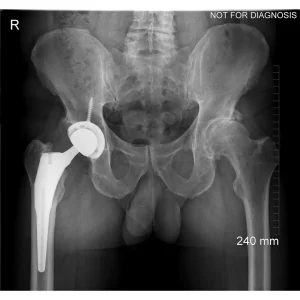 Left Total Hip Arthroplasty Result