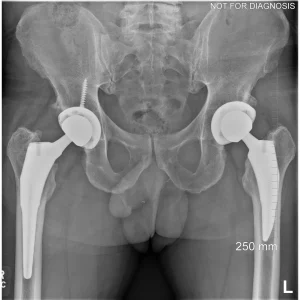Left Total Hip Arthroplasty Result
