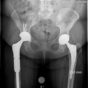 Complex limb salvage using a proximal femoral megaprosthesis for deep prosthetic joint infection (PJI).