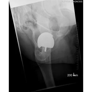 Lateral view confirming neutral stem alignment within the femoral canal.