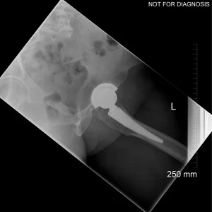 Post-op Lateral Implant View