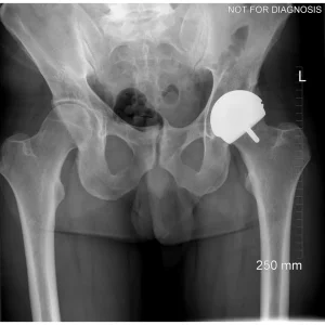 Standing X-ray confirming restored hip biomechanics and leg length equality.
