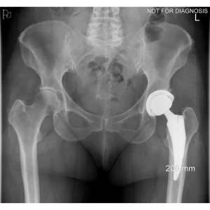 Post-op Standing Weight-Bearing
