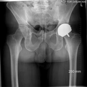 Supine view verifying acetabular cup inclination and femoral stem version.