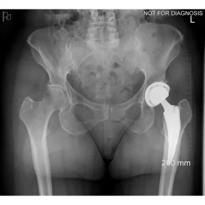 Post-op Supine Pelvis Check