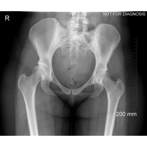 Anterior-Posterior (AP) view of the pelvis showing hip osteoarthritis prior to replacement.