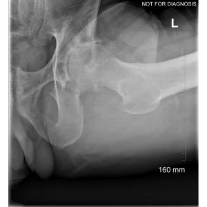 Lateral view for assessing femoral neck version and acetabular morphology.