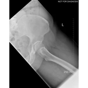 Pre Op Lateral Pre-op Lateral Hip ViewKb