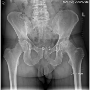Standing AP X-ray evaluating functional pelvic tilt and joint space narrowing under load.