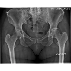 Pre-op Standing Pelvis X-ray