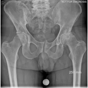 Supine X-ray used to assess leg length and offset without weight-bearing distortion.