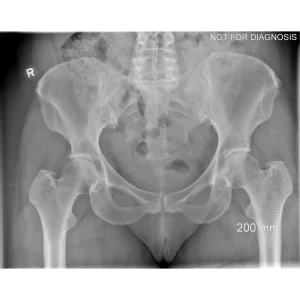 Pre-op Supine Pelvis X-ray