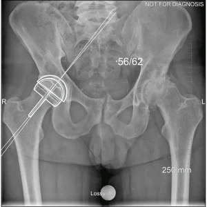Pre-operative TempLateraledon Non Pathological Side - Clinical X-ray view.